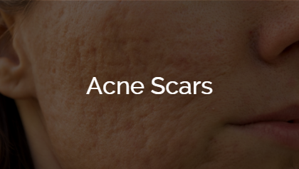 Acne Scars